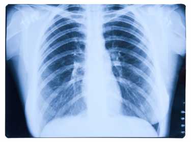 早期发现慢性阻塞性肺病有助于预防肺癌