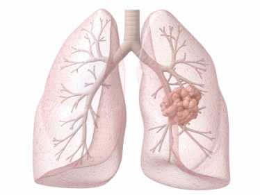 吸烟者中的肺癌肿瘤有10倍的遗传突变